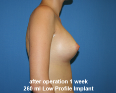 plastic-surgery-breast-augmentation